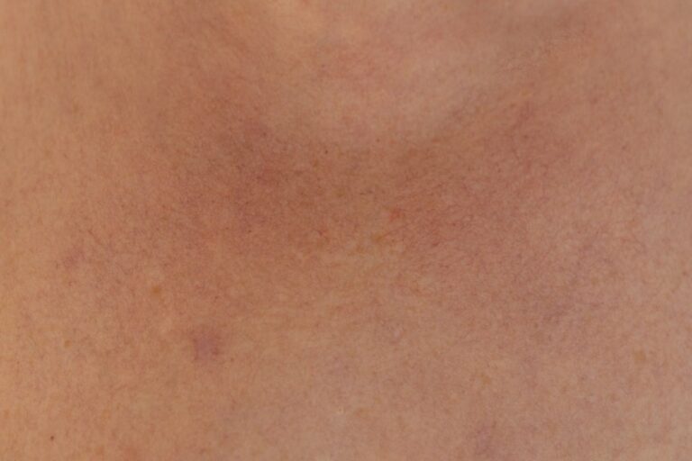 Photo Skin rash