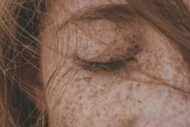 Photo oxidative stress premature aging